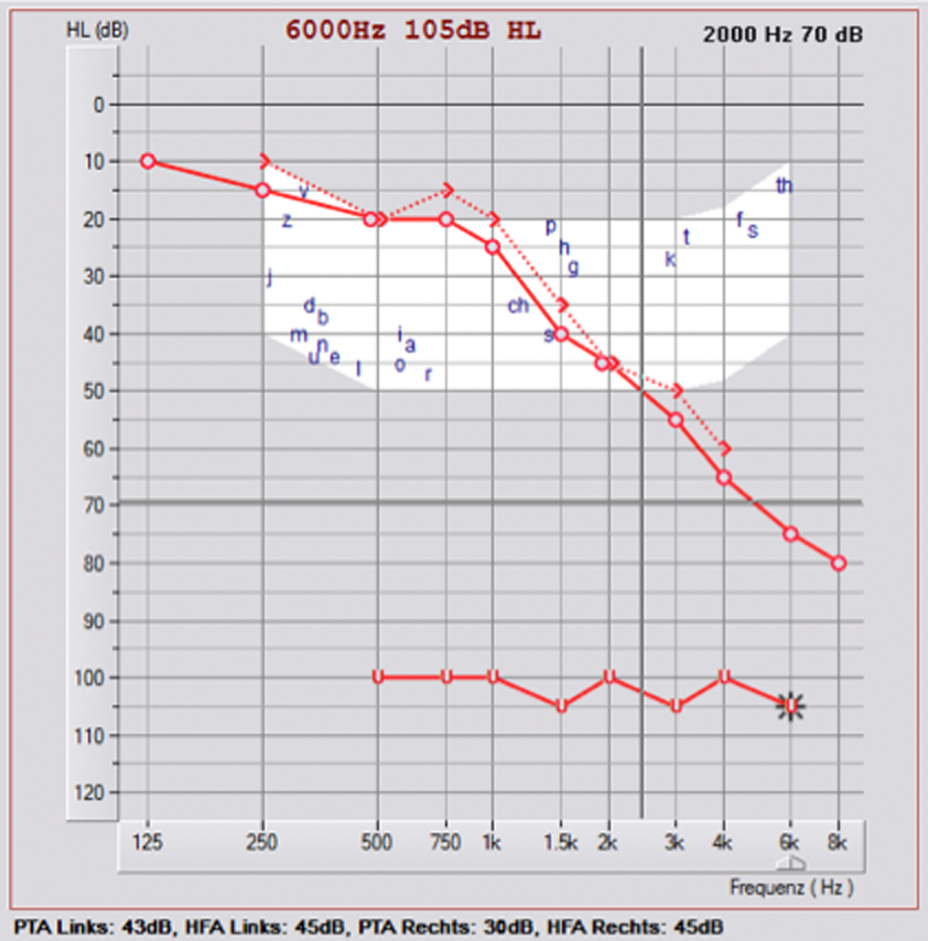 1. Tonaudiogramm