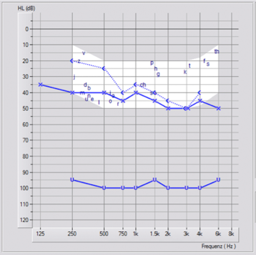 2. Tonaudiogramm