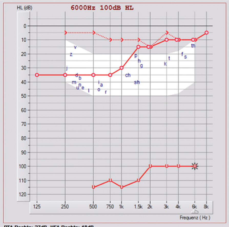 3. Tonaudiogramm